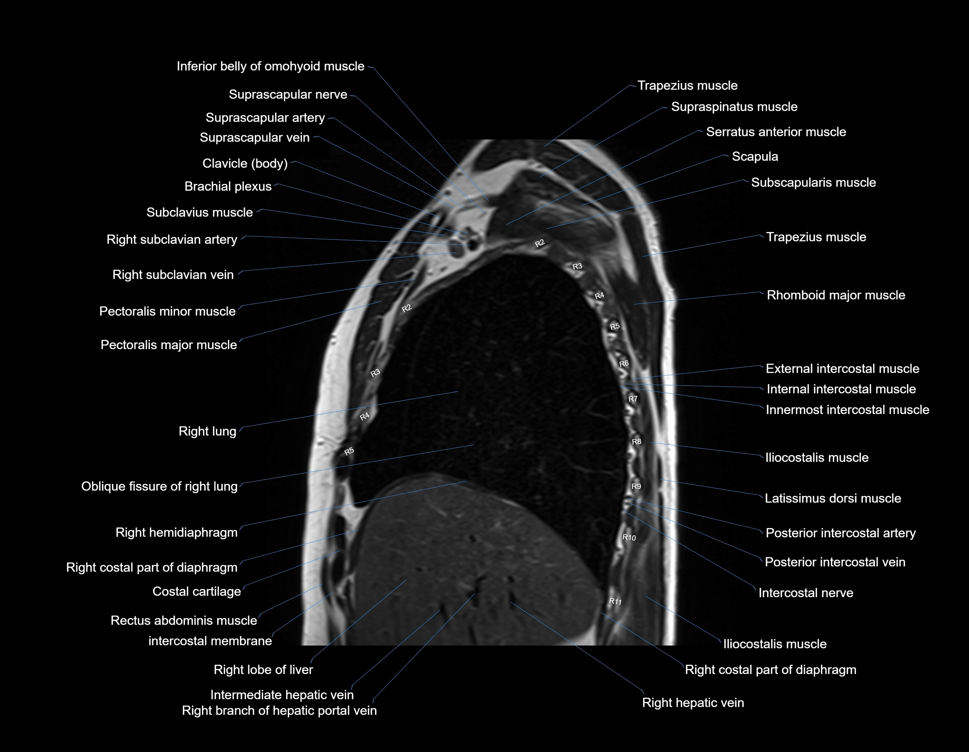 MRI chest (thorax) sagittal labelled cross sectional anatomy 3T radiology image-img-00001-00011.webp